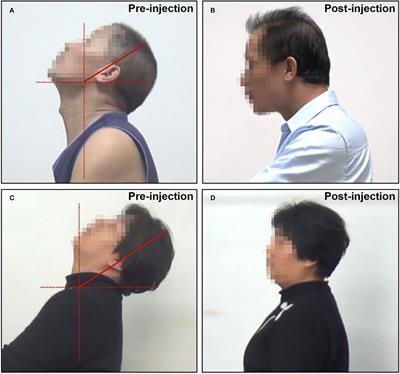 Retroform Cervical Dystonia: Target Muscle Selection and Efficacy of Botulinum Toxin Injection